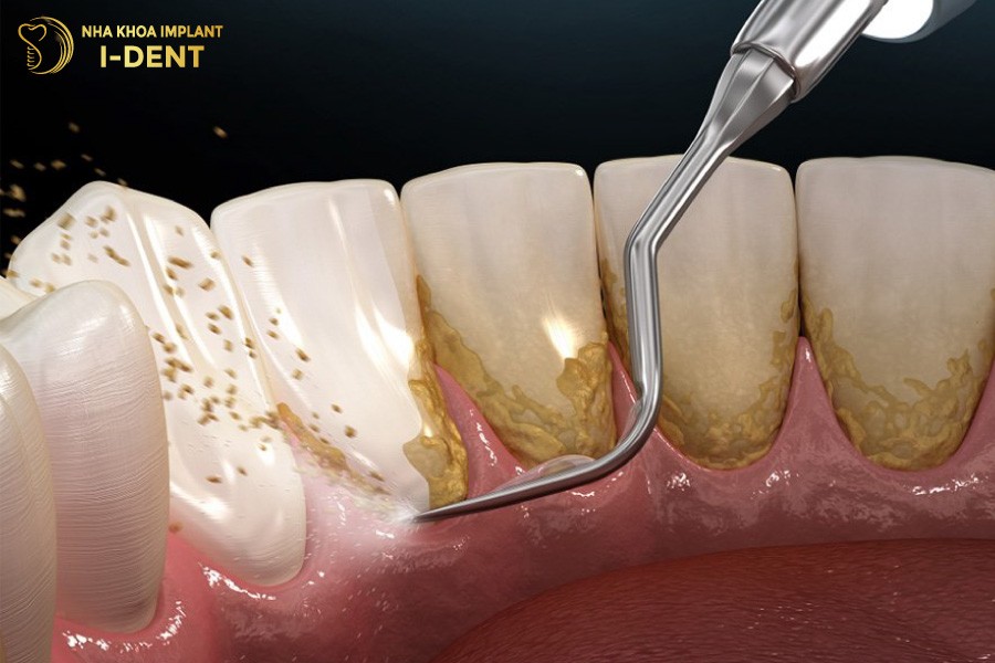 Những Cách Điều Trị Sâu Răng Tại Nhà Hiệu Quả