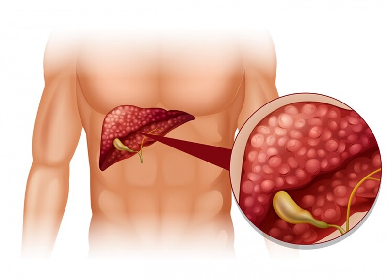 SGOT trong xét nghiệm máu là gì? Chỉ số này thay đổi là do đâu?