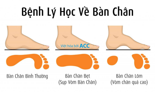 7 câu hỏi thường gặp về hội chứng bàn chân bẹt